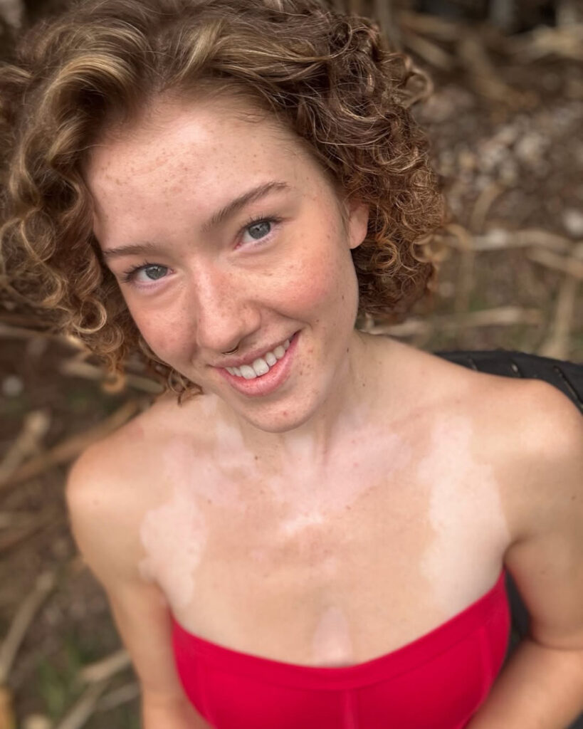 Instagram – frecklesalanna – Nude Leaks